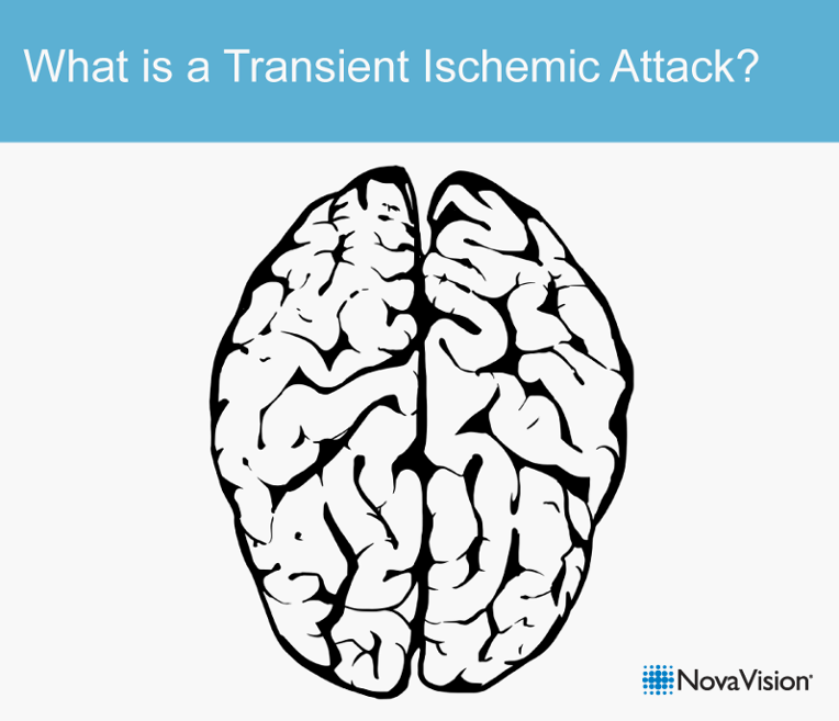 What Is A Transient Ischemic Attack?