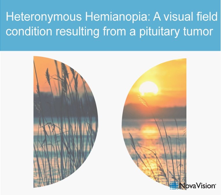 Heteronymous Hemianopia: A Visual Field Condition Resulting From A Pituitary Tumor